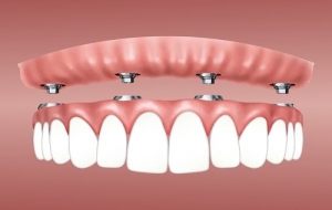 23 febbraio. L’implantologia nella riabilitazione funzionale  del cavo orale